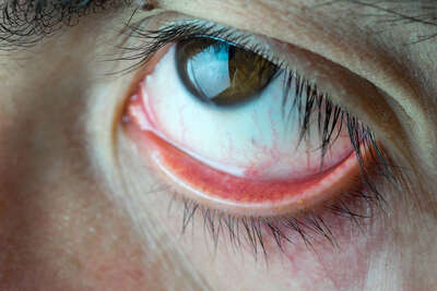 Fremdkörpergefühl im Auge? Ursache und Lösung bei trockenen Augen mit Lidhygiene